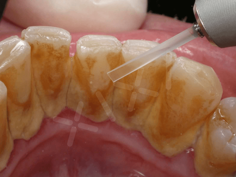 Tác hại của cao răng